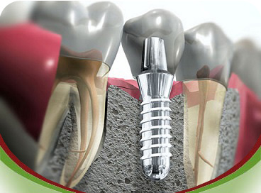 Prótesis Dental - Implantología - bucaramanga