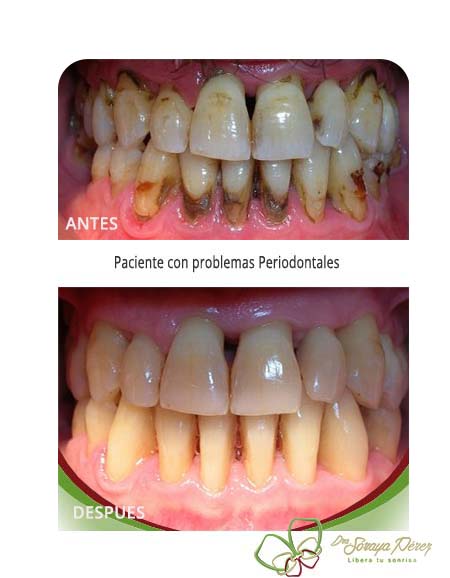 Paciente con problemas periodontales - Antes y despues del tratamiento