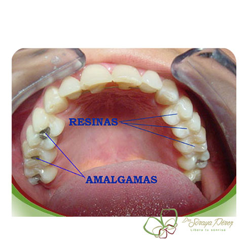 Incrustaciones en Resina y Ceramica de Alta estética