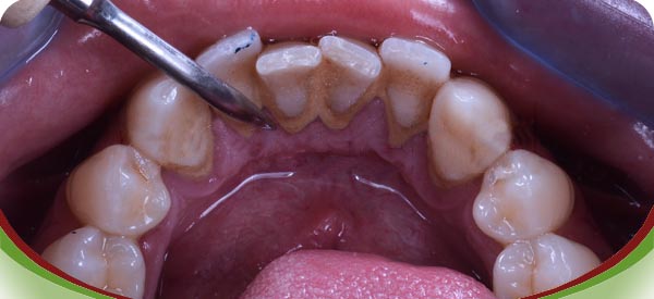 Limpieza sarro dental