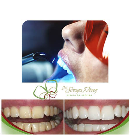Blanquiamiento Dental - Bucaramanga - Colombia