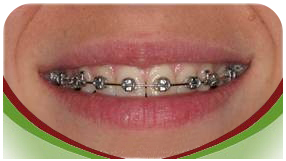 brackets baja friccion